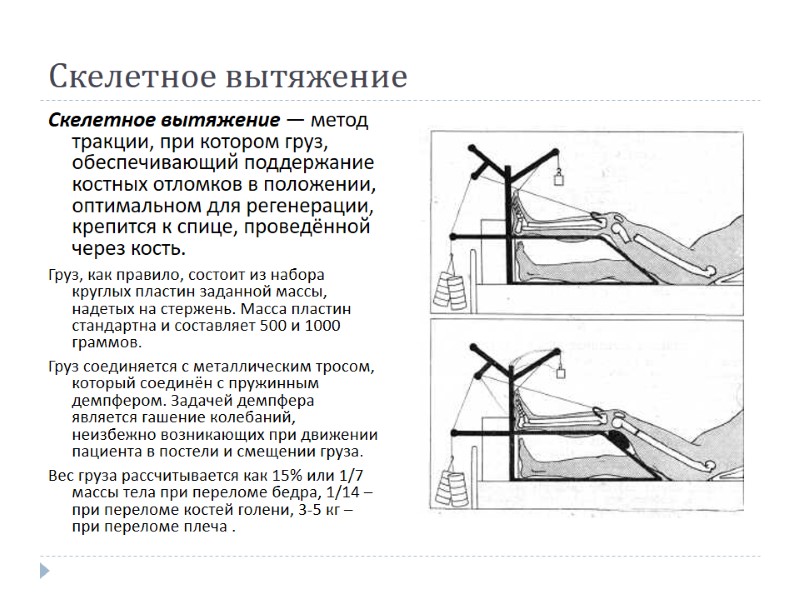 Скелетное вытяжение Скелетное вытяжение — метод тракции, при котором груз, обеспечивающий поддержание костных отломков
